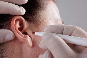 Otoplastia