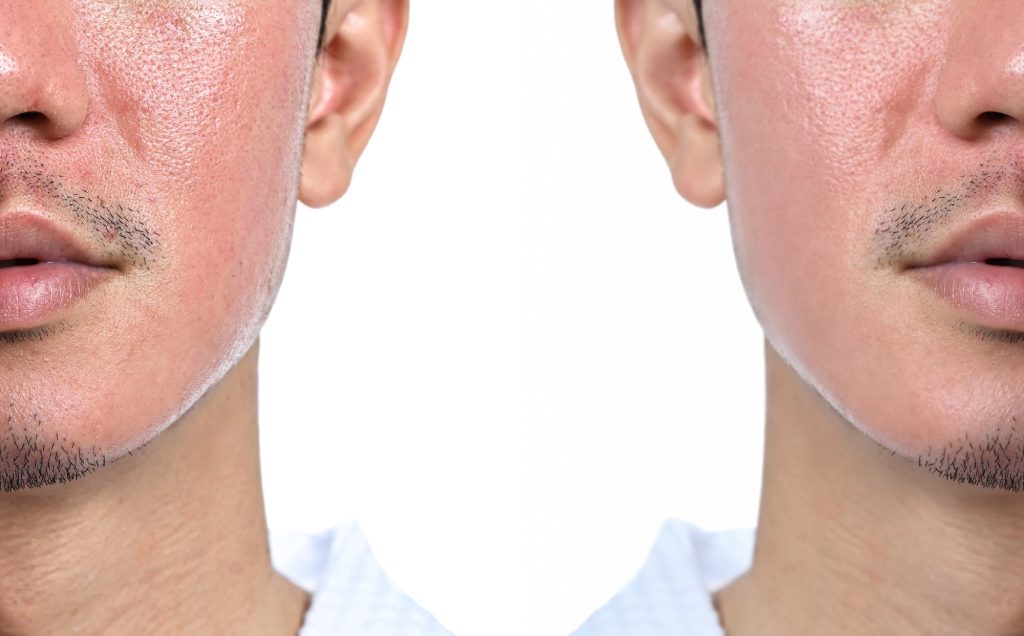 Comparison of skin before and after laser treatment, skin with acne scars and enlarged pores