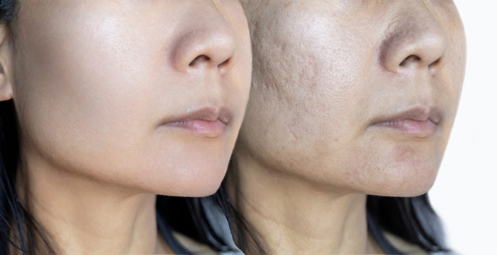 Skin problems and acne scar, Before and after acne facial care treatment, Beauty concept.
