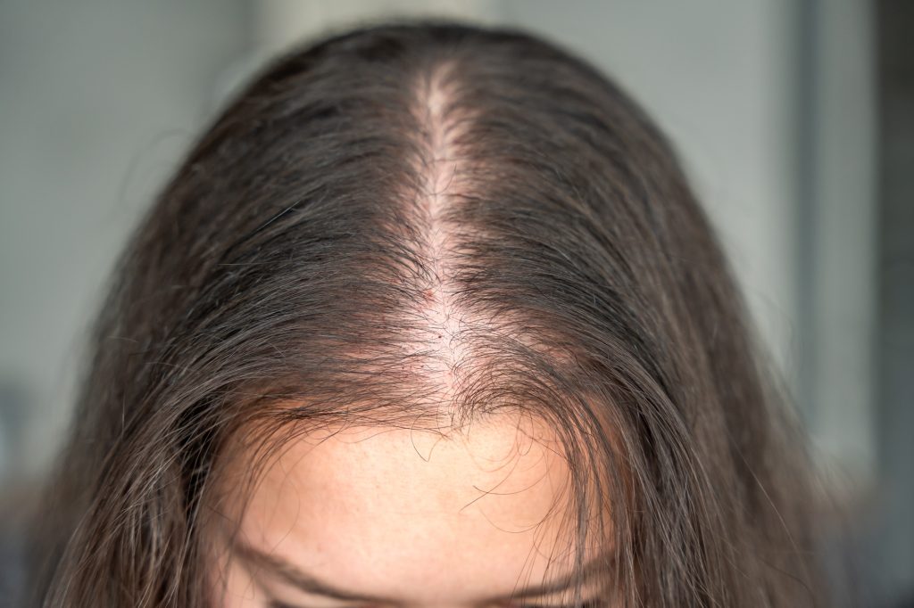 Close-up view of the head with traces of blood from injections after mesotherapy, treatment of