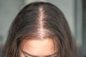 Mesoterapia capilar con fármacos