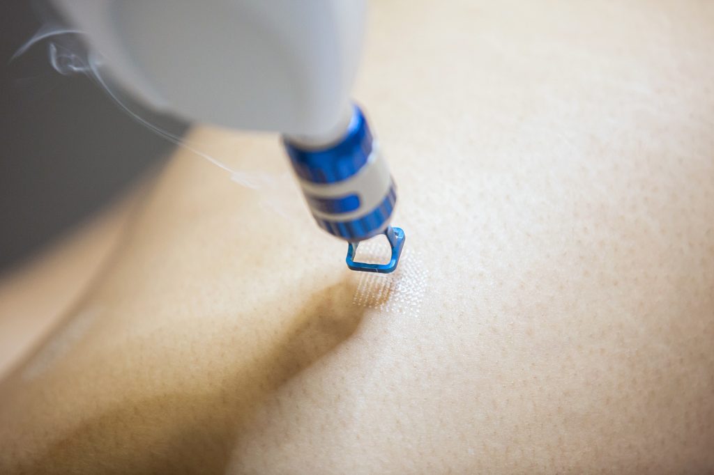 Laser hair or scar removal from the skin. CO2 technique.