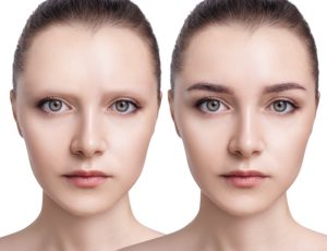 Implante de barba, cejas y línea frontal femenina