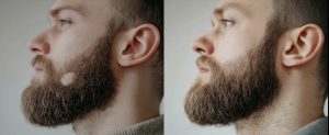 Alopecia areata