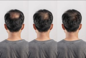 Protocolo anti-caída masculina