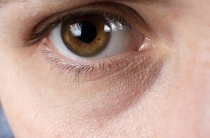 Tratamiento de ojeras