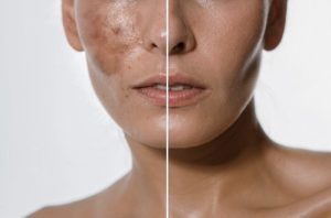 Peeling químico
