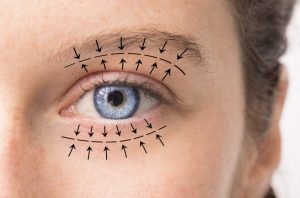 Blefaroplastia