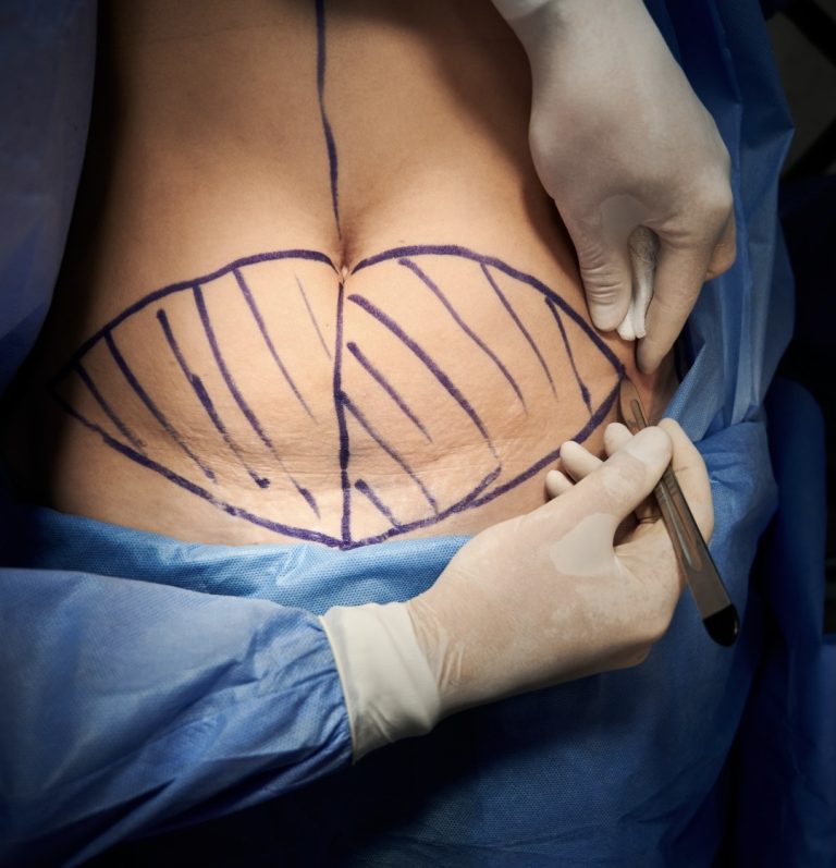 Abdominoplastia + liposucción