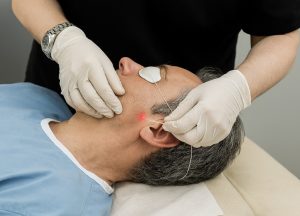 Endolift facial y cuello