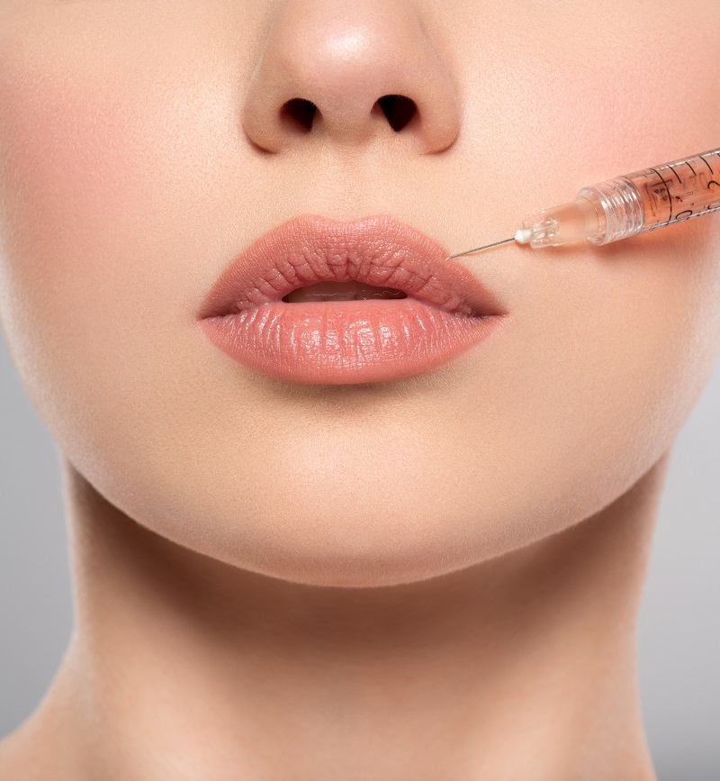 Procedimiento de medicina estética para mejorar labios