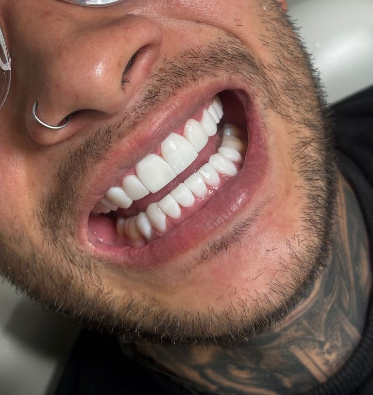 Resultado carillas dentales Clinica Odda Barcelona