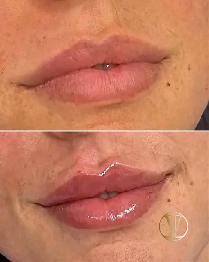 Caso real de labios rusos en Clínica Odda Barcelona