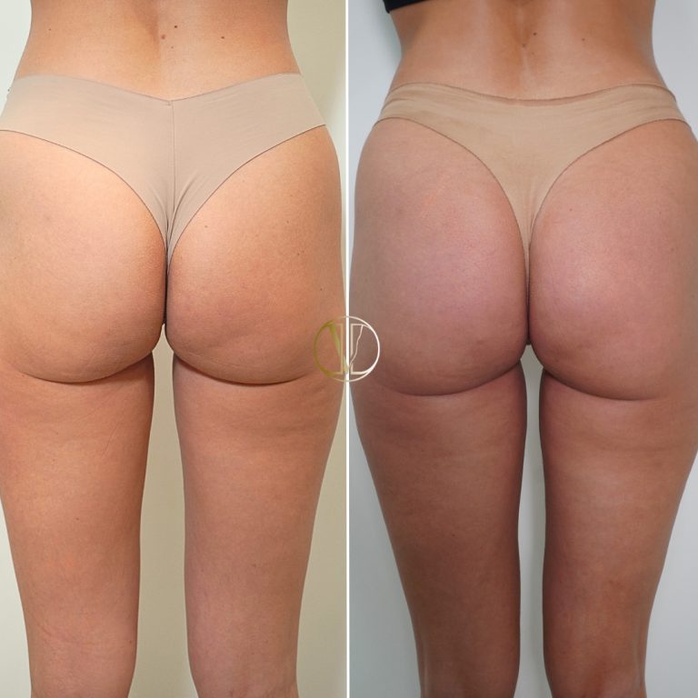 Caso real de mesoterapia corporal en Clínica Odda