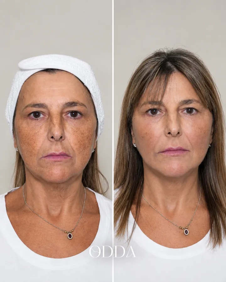 Armonización facial caso 1, vista frontal, antes y después. Clínica ODDA Barcelona
