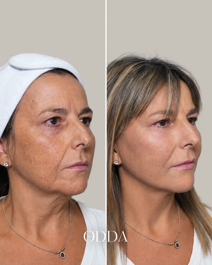 Armonización facial caso 1, vista oblicua derecha, antes y después. Clínica ODDA Barcelona