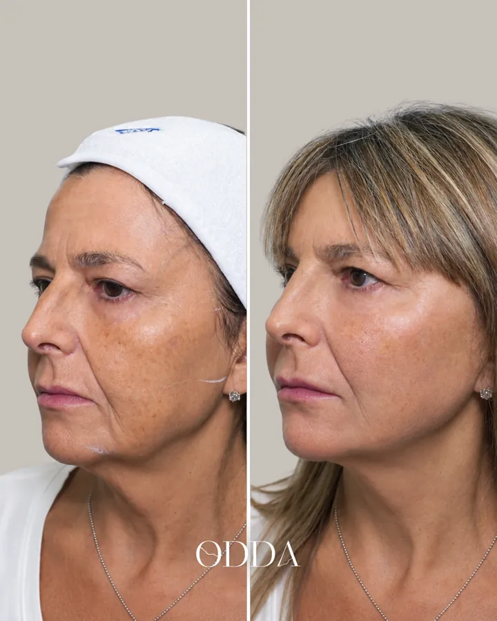 Armonización facial caso 1, vista oblicua izquierda, antes y después. Clínica ODDA Barcelona