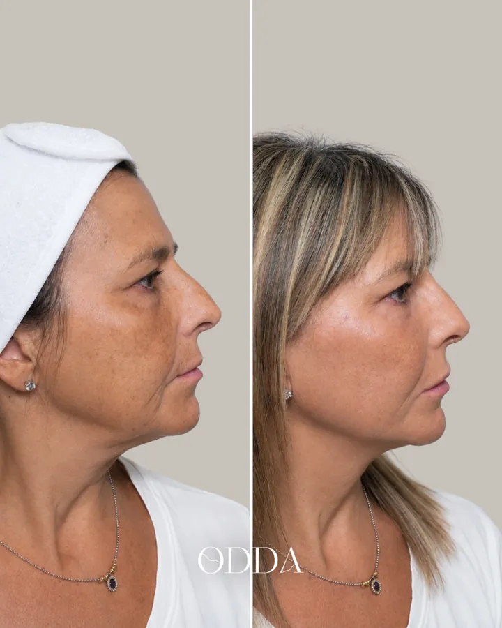 Armonización facial caso 1, perfil derecho, antes y después. Clínica ODDA Barcelona