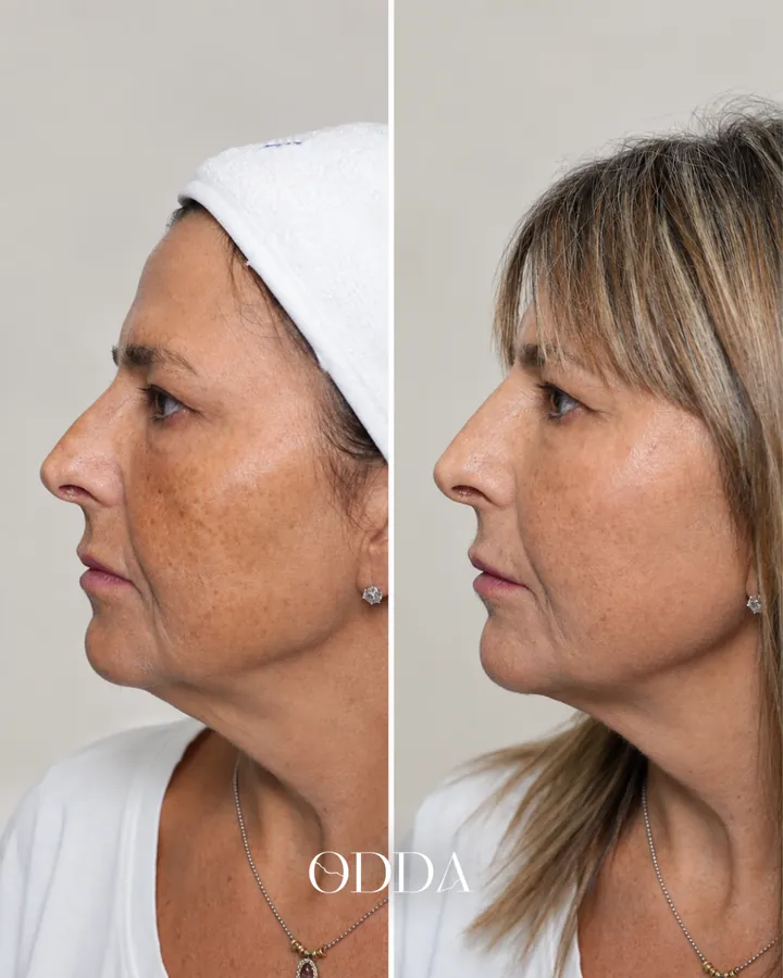 Armonización facial caso 1, perfil izquierdo, antes y después. Clínica ODDA Barcelona