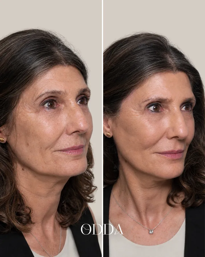 Armonización facial caso 2, vista oblicua derecha, antes y después. Clínica ODDA Barcelona