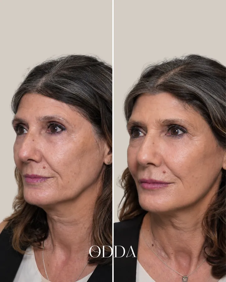 Armonización facial caso 2, vista oblicua izquierda, antes y después. Clínica ODDA Barcelona