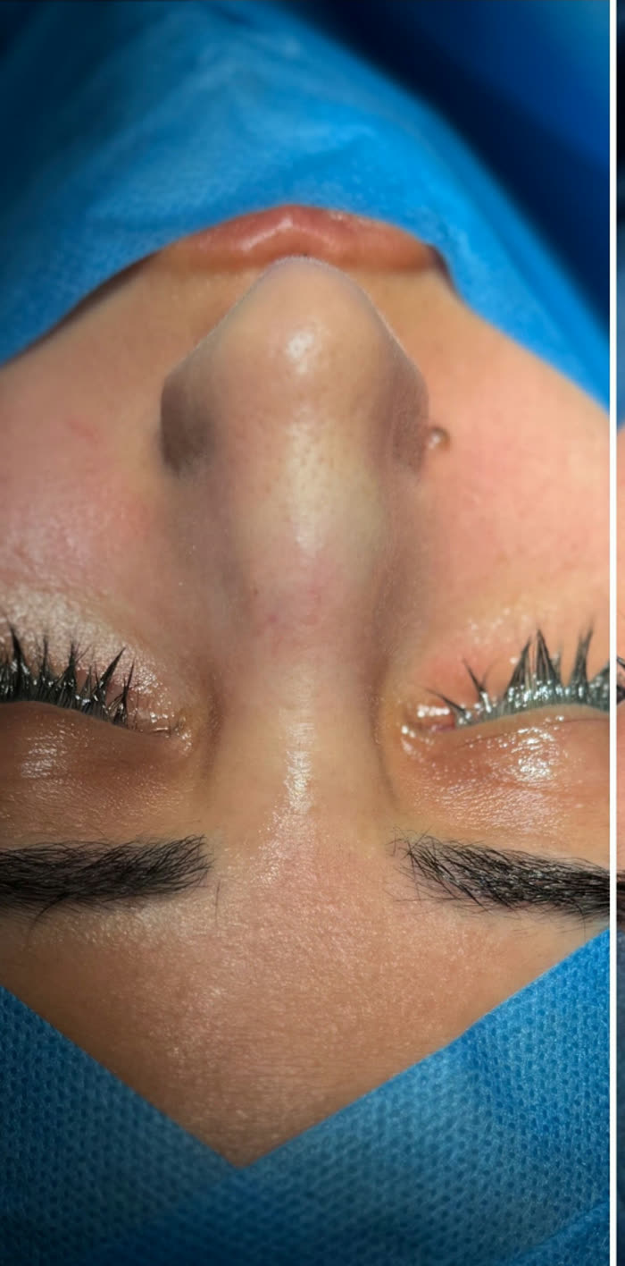 Rinoplastia ultrasónica, antes