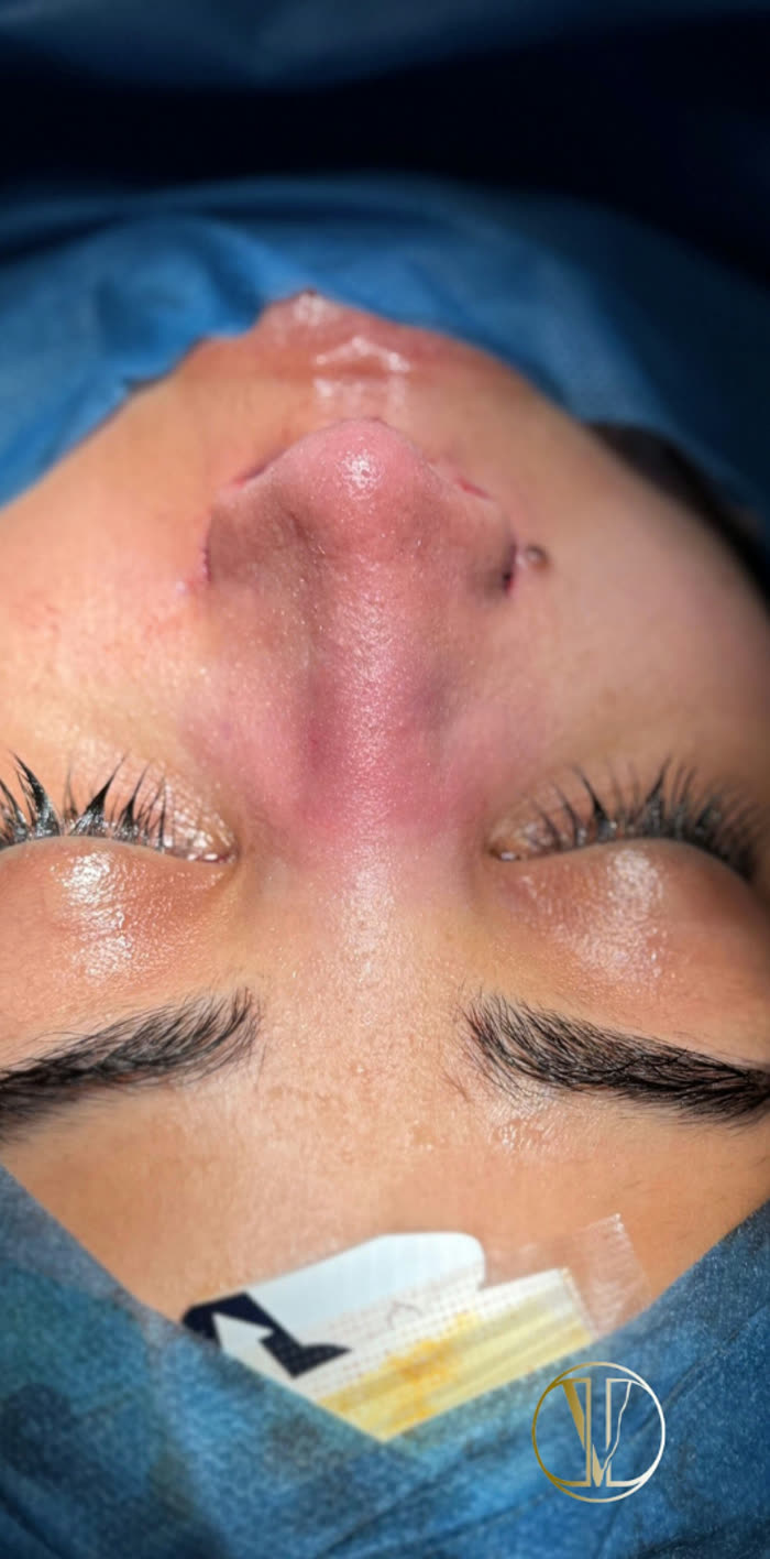 Rinoplastia ultrasónica, después