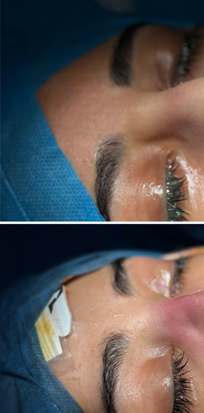 Rinoplastia ultrasónica, perfil, antes