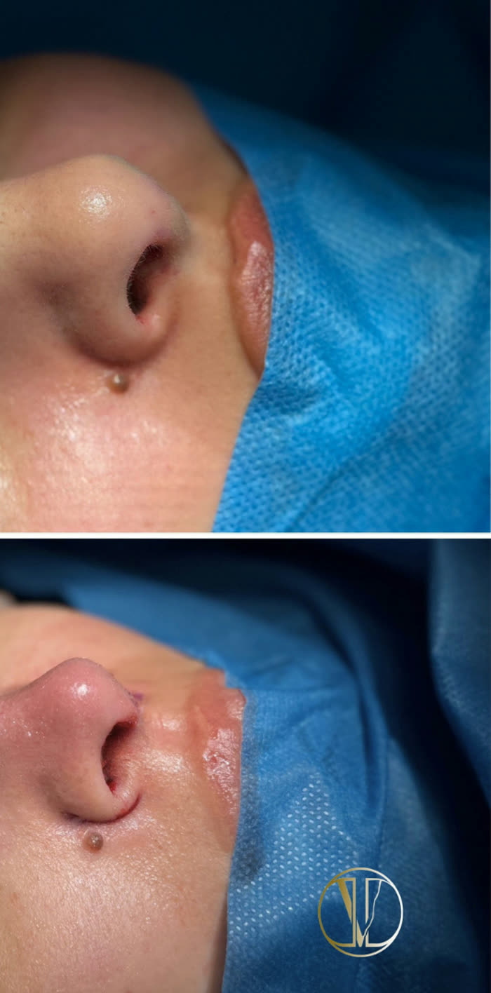 Rinoplastia ultrasónica, perfil, después