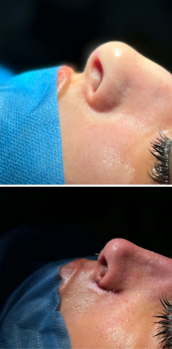 Rinoplastia ultrasónica, tres cuartos, antes