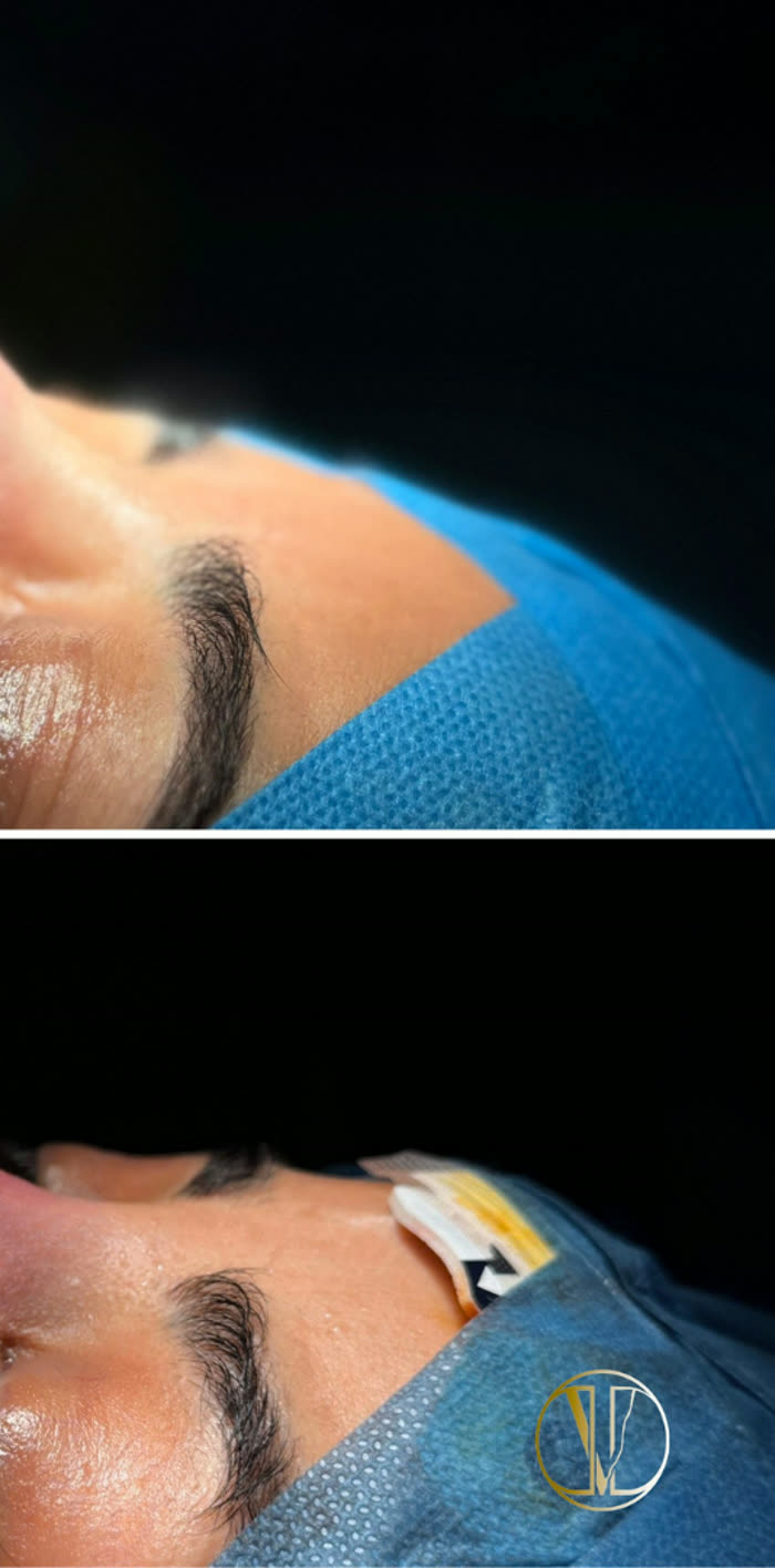 Rinoplastia ultrasónica, tres cuartos, después