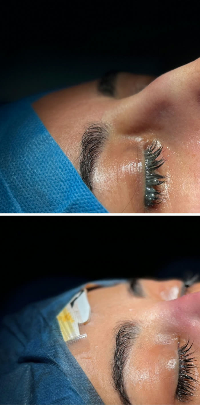 Rinoplastia ultrasónica, detalle, antes
