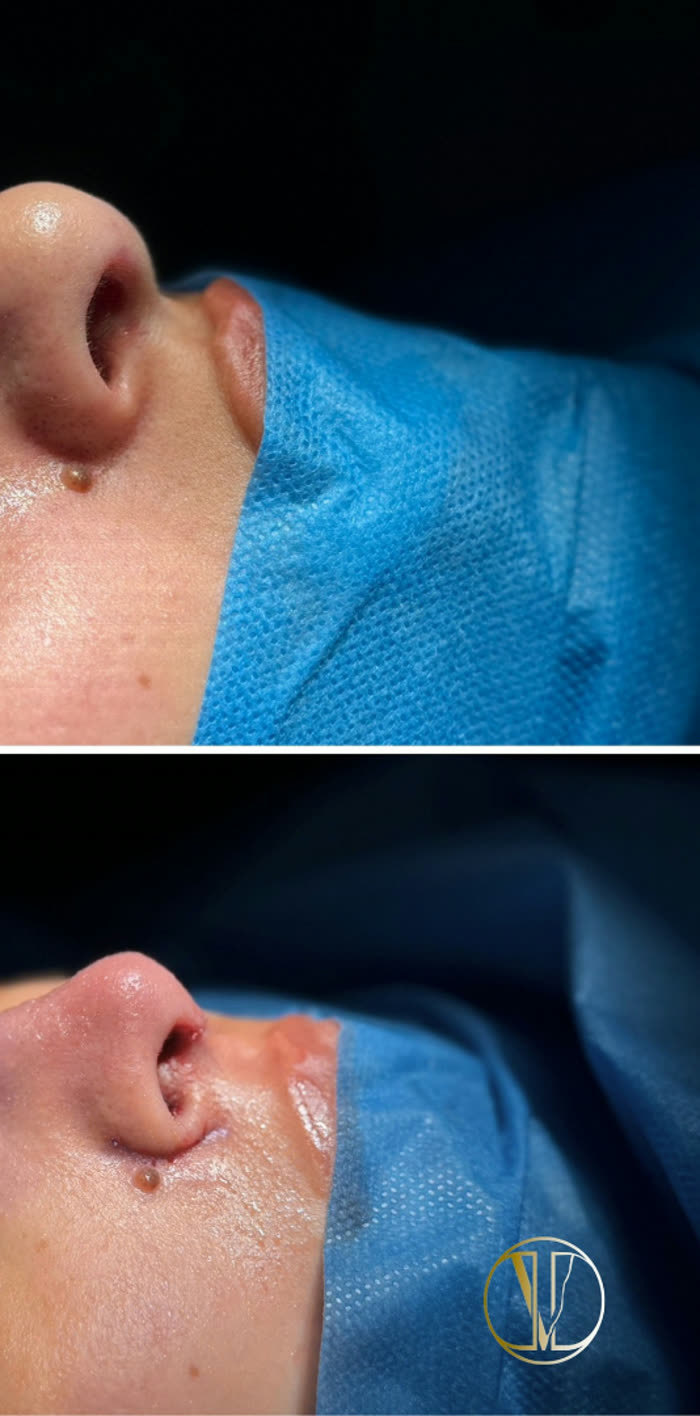 Rinoplastia ultrasónica, detalle, después