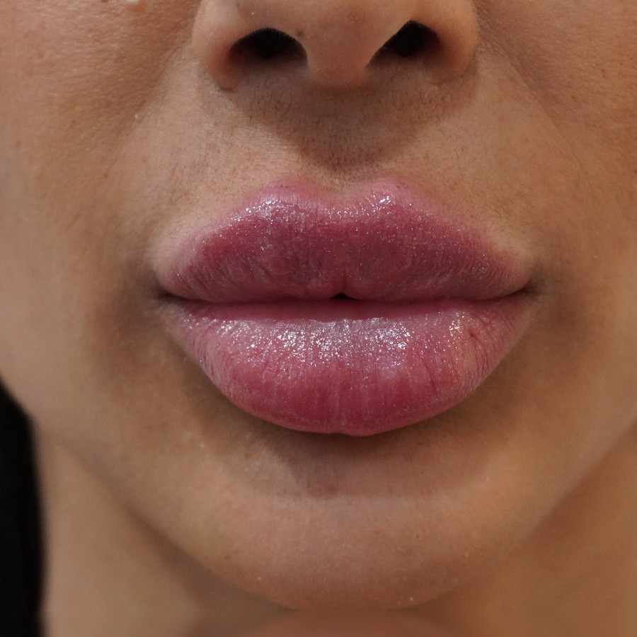 Aumento de labios con ácido hialurónico, caso 1, después