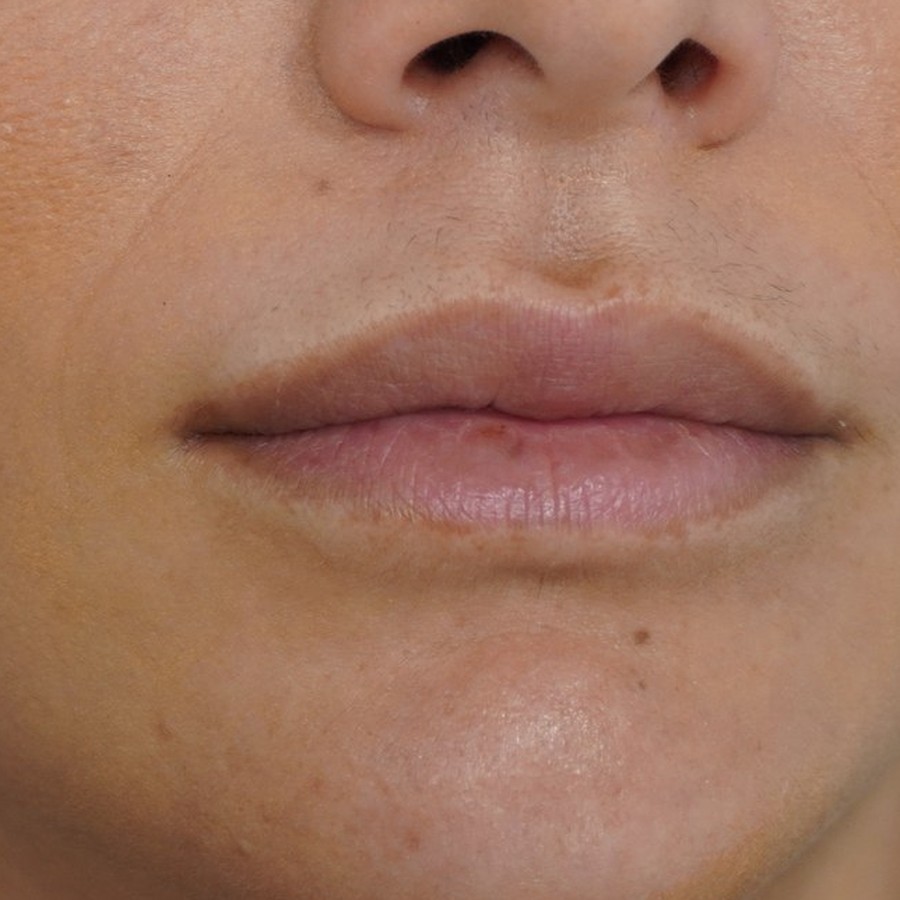 Aumento de labios con ácido hialurónico, caso 2, antes
