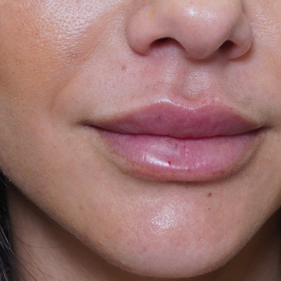 Aumento de labios con ácido hialurónico, caso 2, después