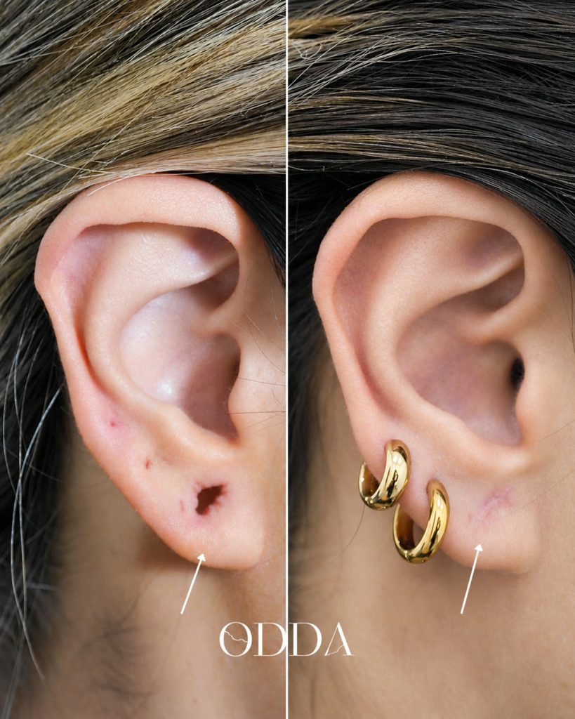 Lobuloplastia, antes y después, caso real ODDA