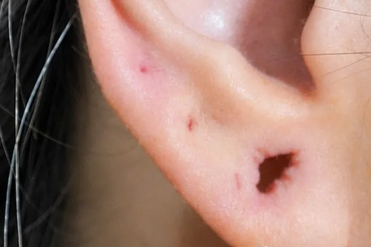 Lóbulo de la oreja con dilatación abierta antes de la lobuloplastia