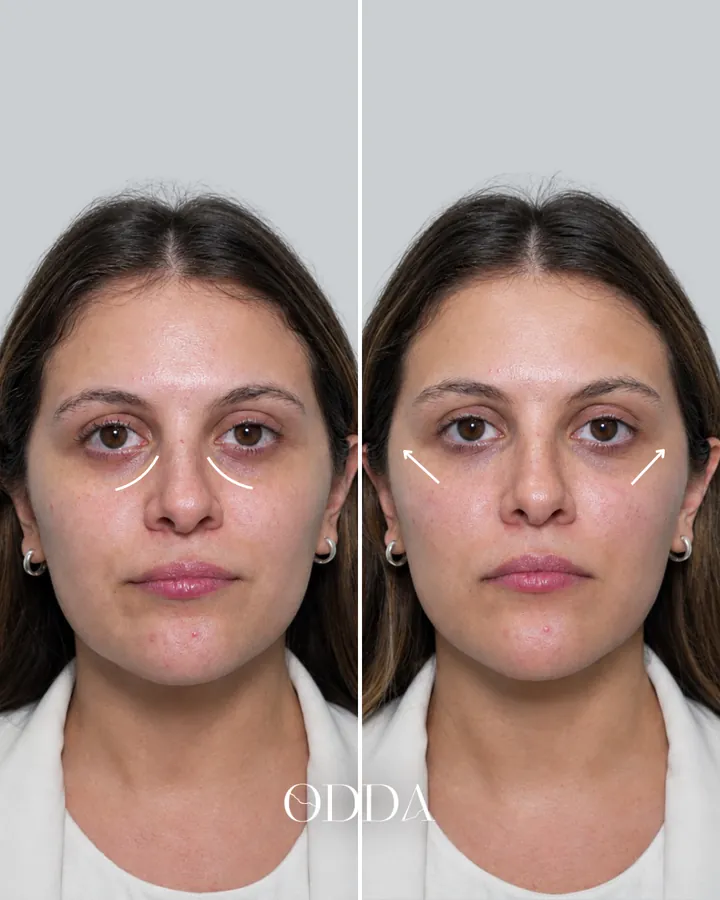 Tratamiento de ojeras, surco lagrimal, vista frontal, antes y después. Clínica ODDA Barcelona