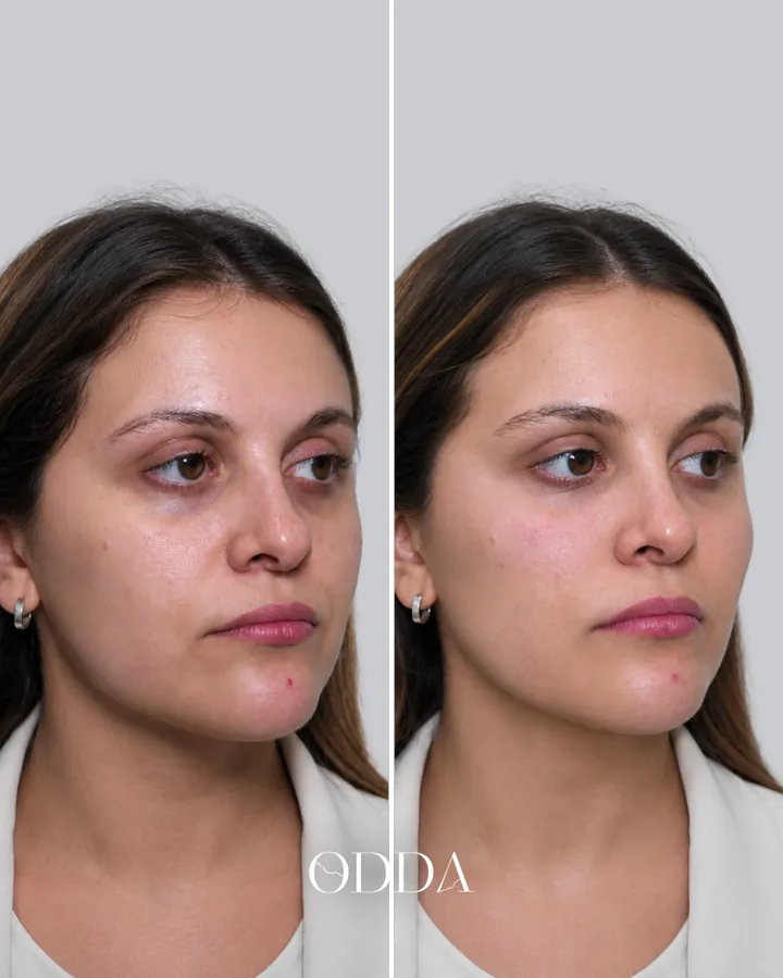 Tratamiento de ojeras, surco lagrimal, vista oblicua, antes y después. Clínica ODDA Barcelona