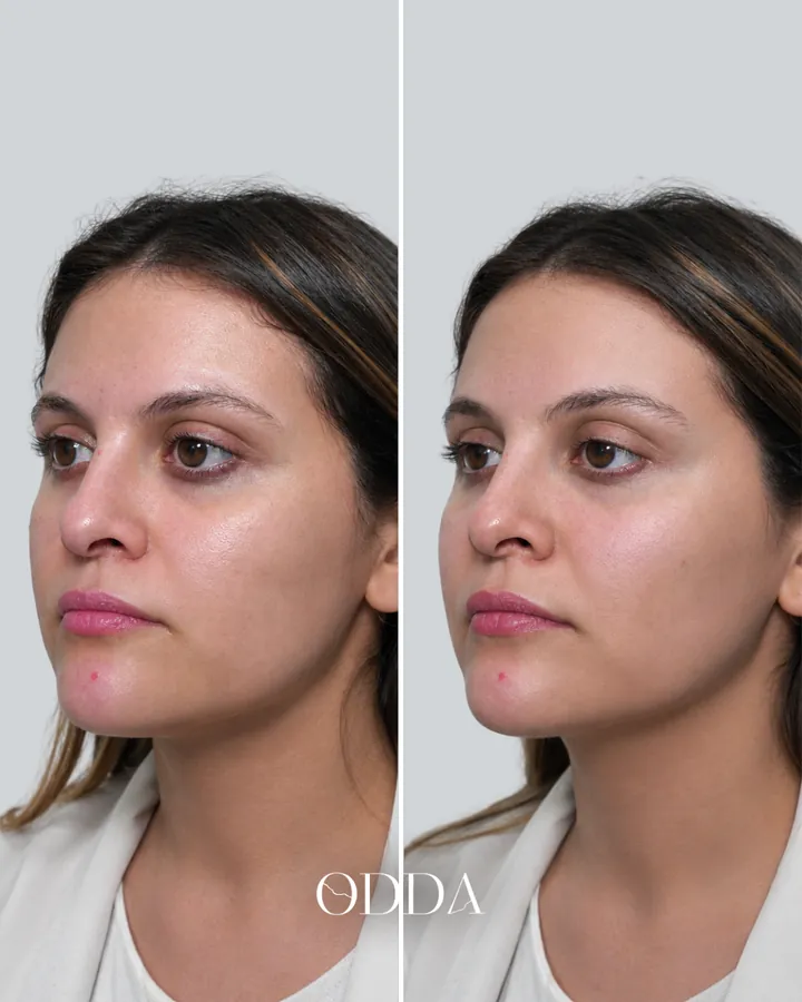 Tratamiento de ojeras, surco lagrimal, vista oblicua izquierda, antes y después. Clínica ODDA Barcelona