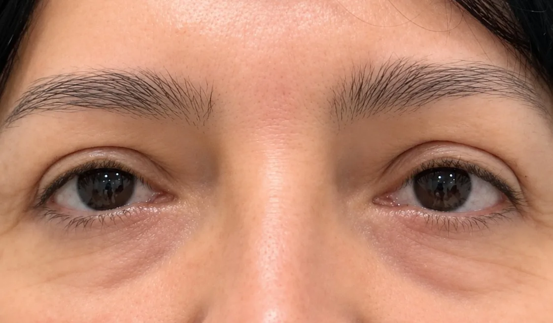 Blefaroplastia en Clínica ODDA