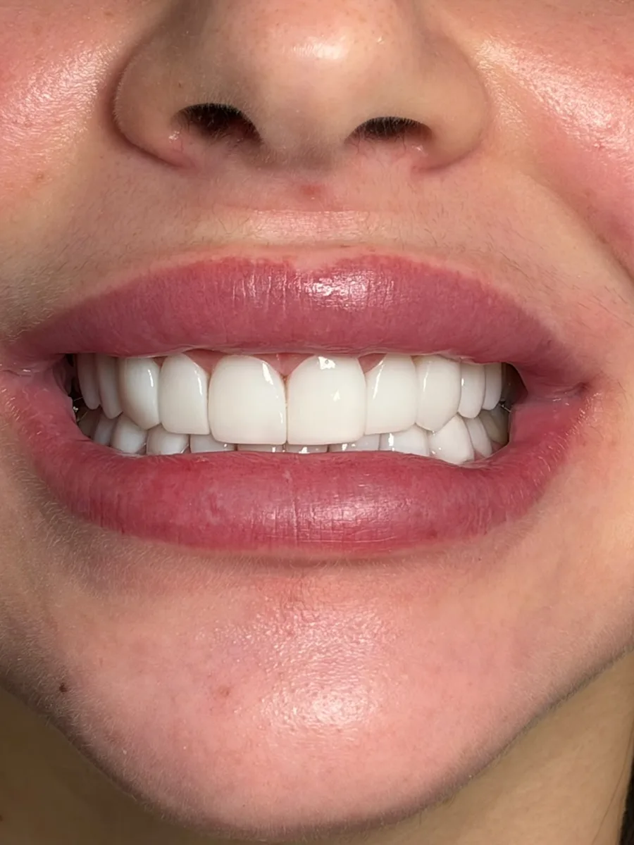 Antes y después de carillas dentales en mujer joven con dientes pequeños y desiguales, resultado de sonrisa blanca y uniforme. Clínica ODDA Barcelona