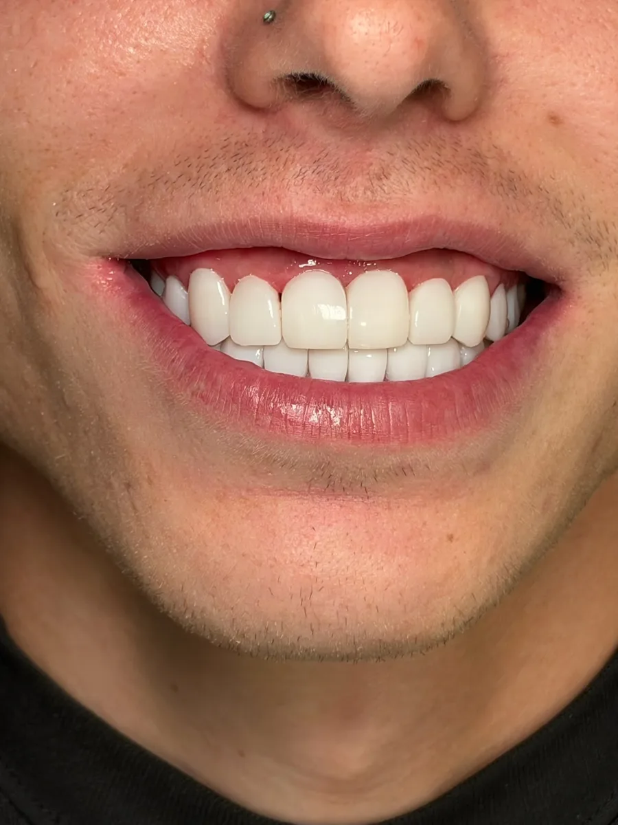 Antes y después de carillas dentales en hombre joven con diastema entre incisivos y dientes amarillentos, espacio cerrado y tono más blanco. Clínica ODDA Barcelona