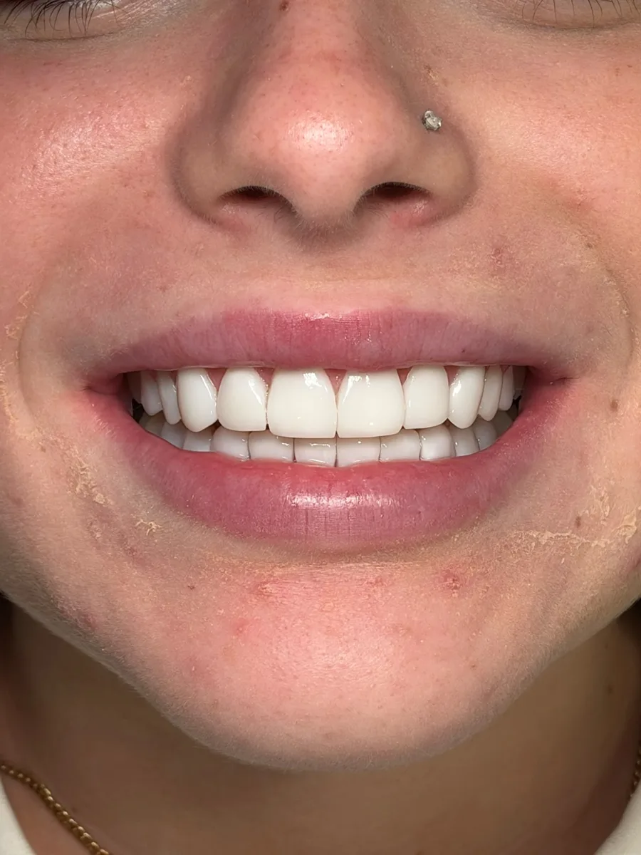 Antes y después de carillas dentales en mujer con dientes amarillentos e irregulares, resultado alineado y de color más claro. Clínica ODDA Barcelona