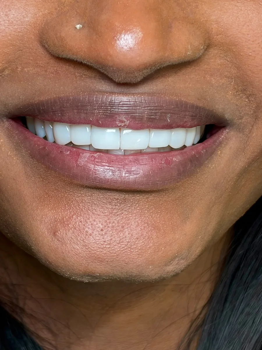 Antes y después de carillas dentales en mujer de piel oscura con dientes pequeños, sonrisa más blanca y con mayor volumen. Clínica ODDA Barcelona