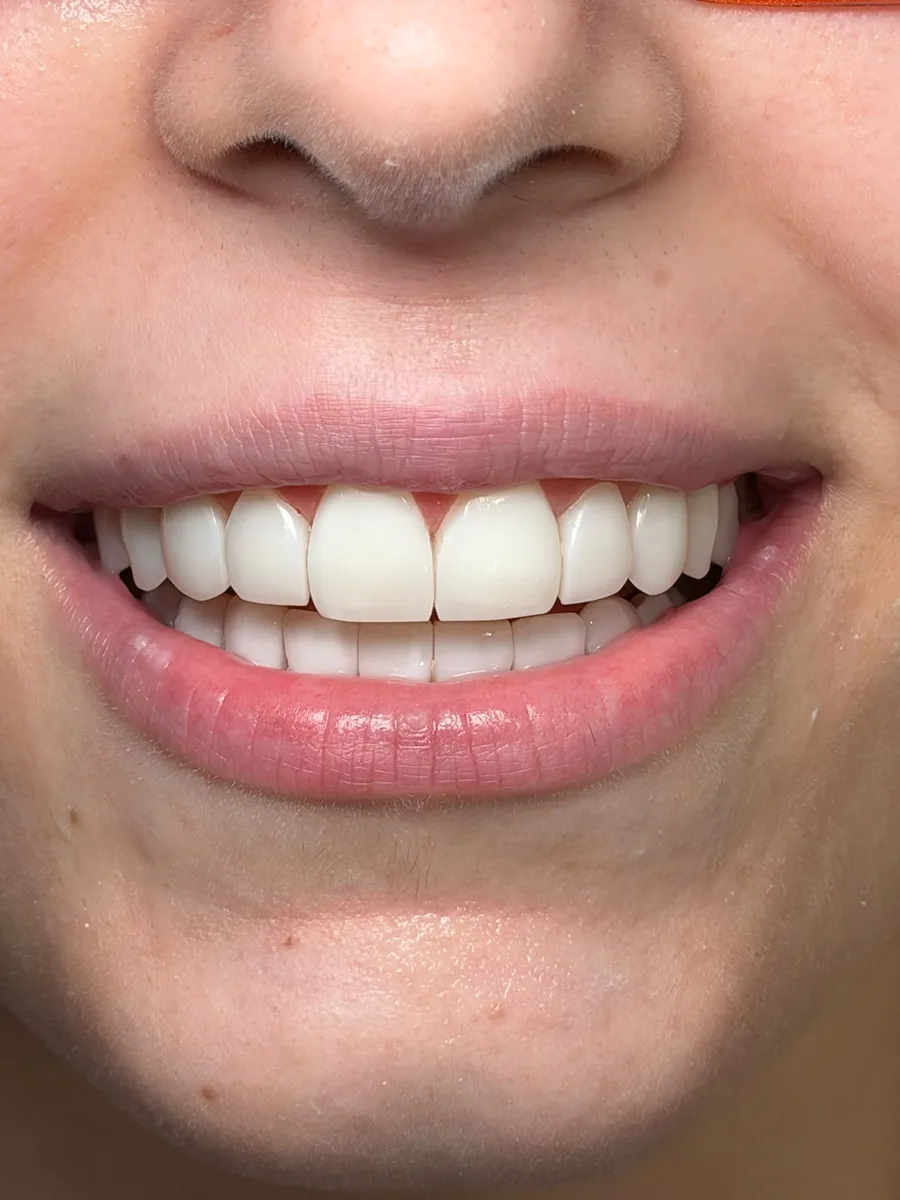 Antes y después de carillas dentales en mujer joven con incisivos irregulares, sonrisa uniforme y luminosa. Clínica ODDA Barcelona