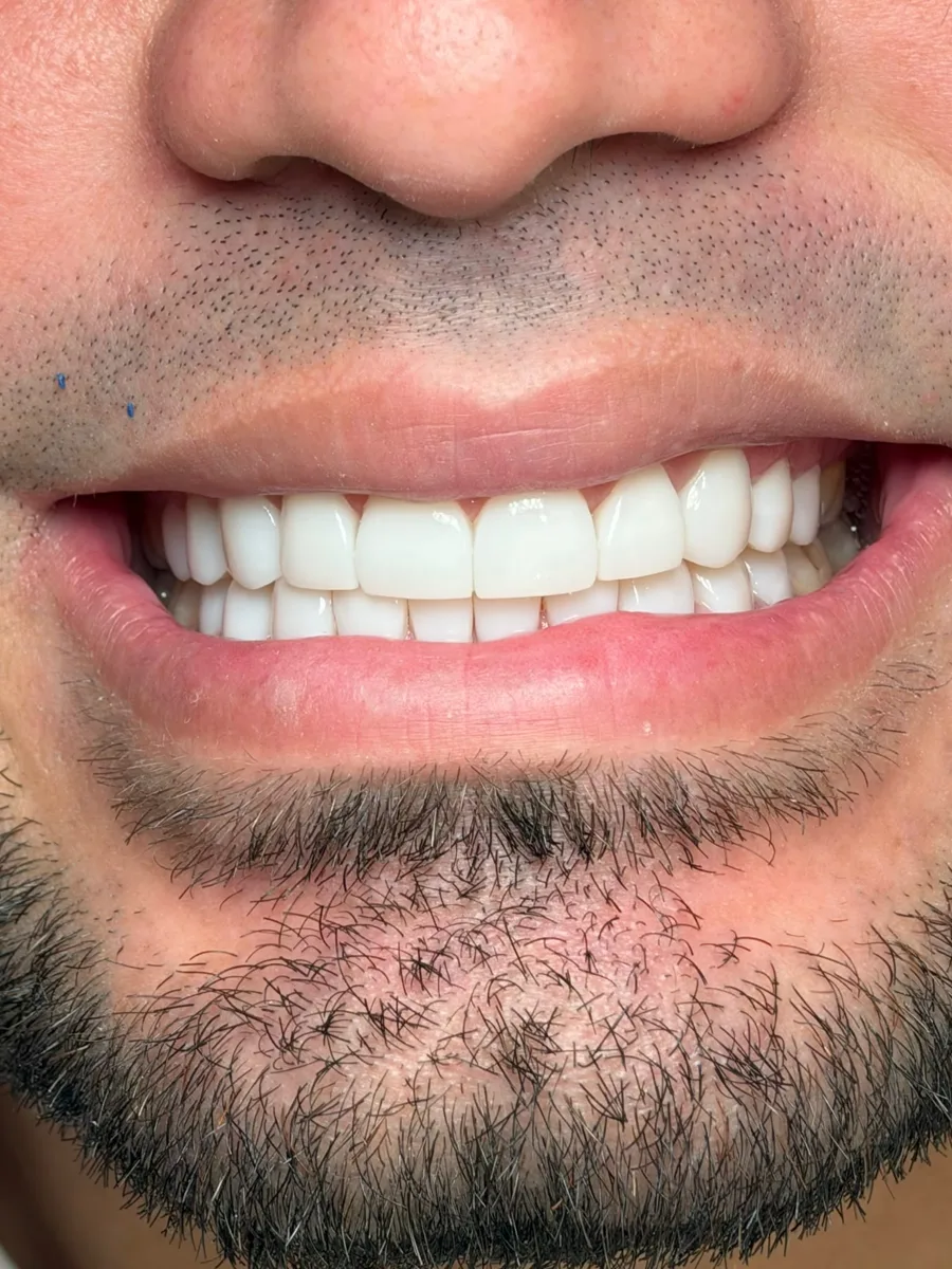 Carillas dentales en Clínica ODDA