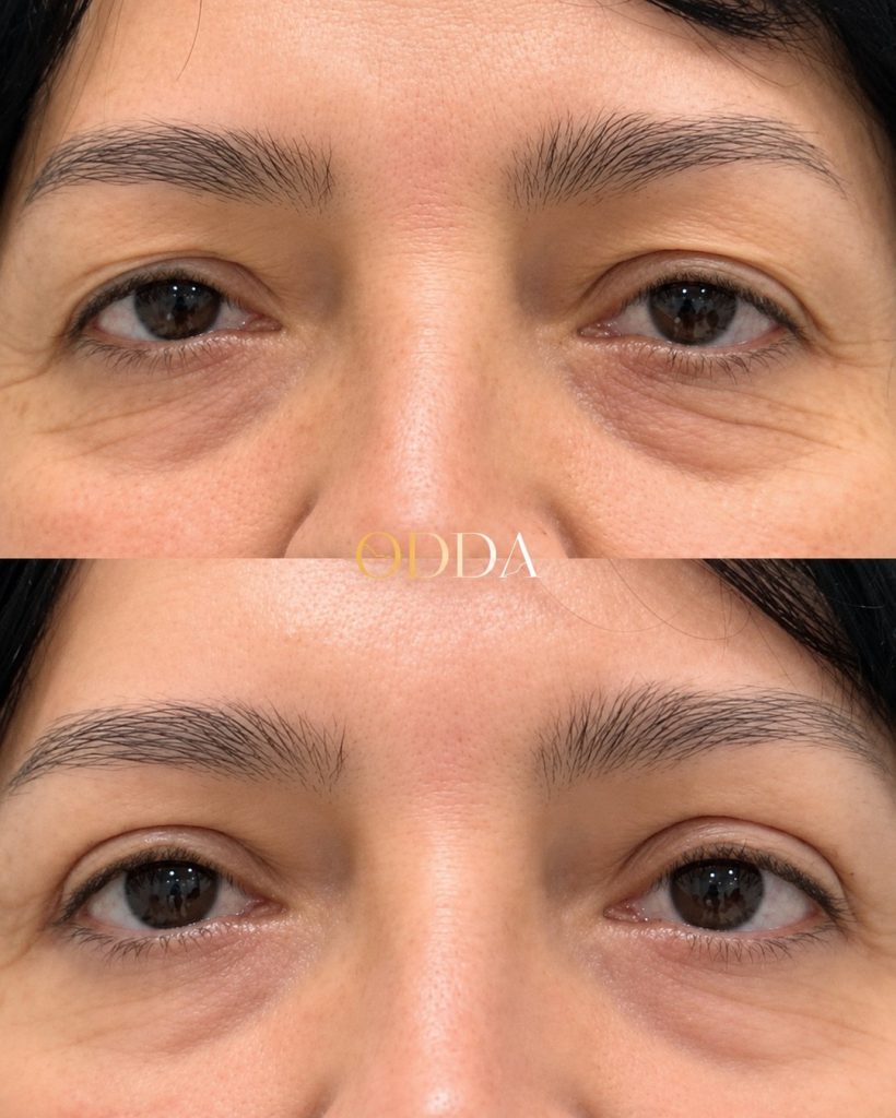 Resultado de blefaroplastia, mirada más fresca, Clínica ODDA Barcelona
