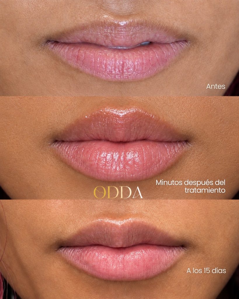 Labios con ácido hialurónico 15 días después, Clínica ODDA Barcelona